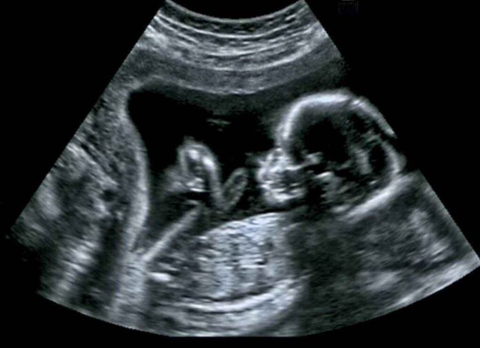 546641992 featured image Ultrasound image of fetus in womb