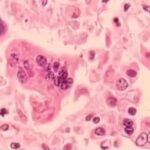 Second measles case of 2026 confirmed in Georgia