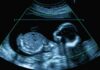 Doctor Botches Late-Term Abortion, Walks Away Fetal ultrasound scan image