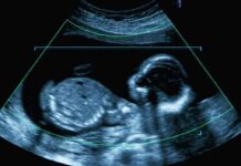 Fetal ultrasound scan image